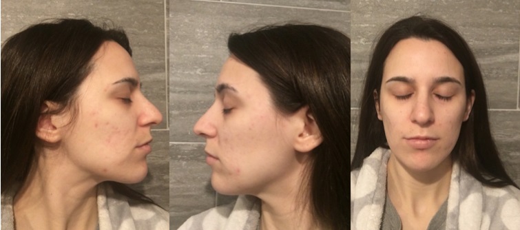 Acne After 10 Treatments